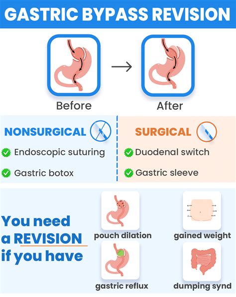 Gastric Bypass Revision Surgery